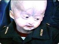 progeria_died.jpg